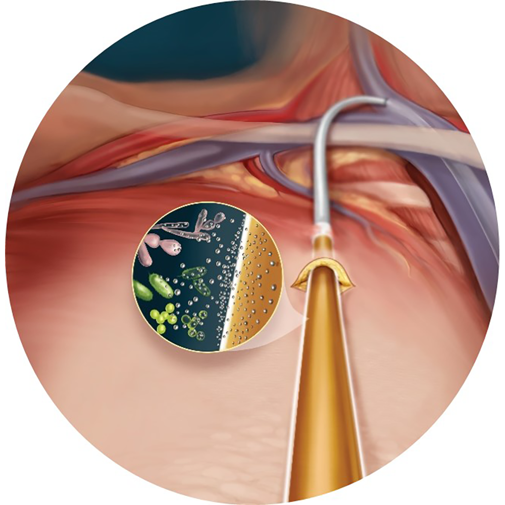 Palindrome™ Precision SI Chronic Catheter – Silver Ion