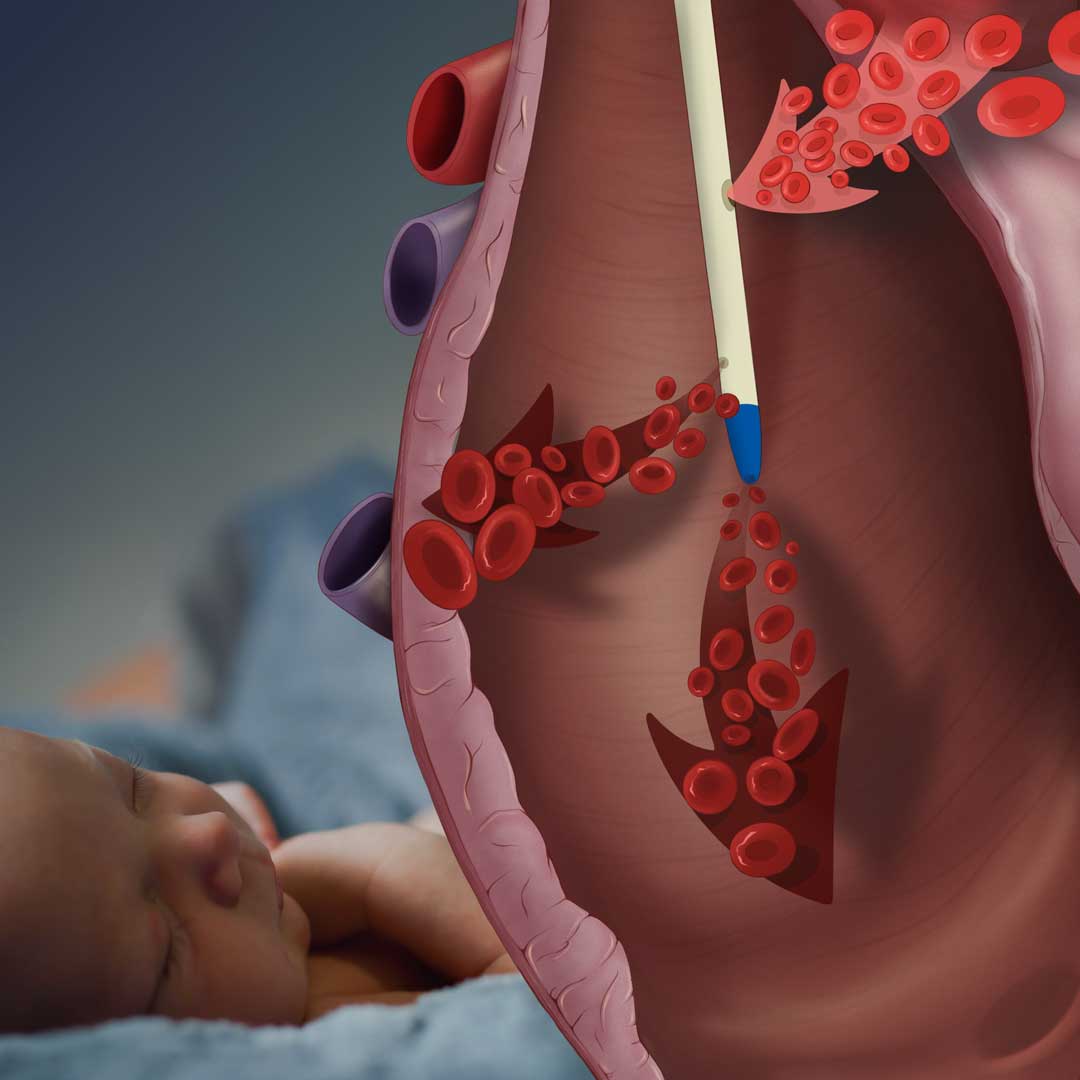 Pediatric hemodialysis catheter options