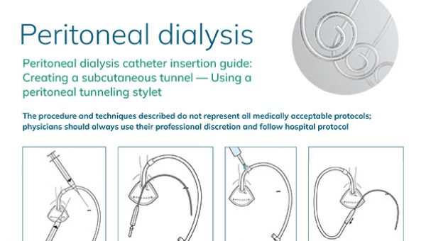 peritoneal-dialysis-subcutaneous-insertion-mozarc-guide-thumbnail